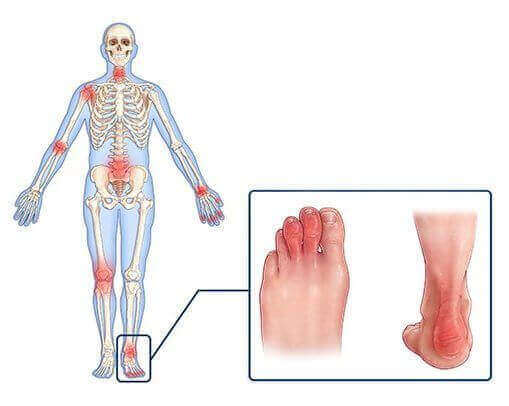 Psoriatic arthritis and its association with autonomic dysfunction